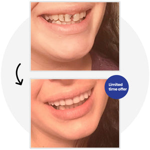 American Smile Veneers