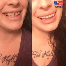 Load image into Gallery viewer, Buy 1 Get 1 FREE - American Smile Veneer (Upper &amp; Lower Set)